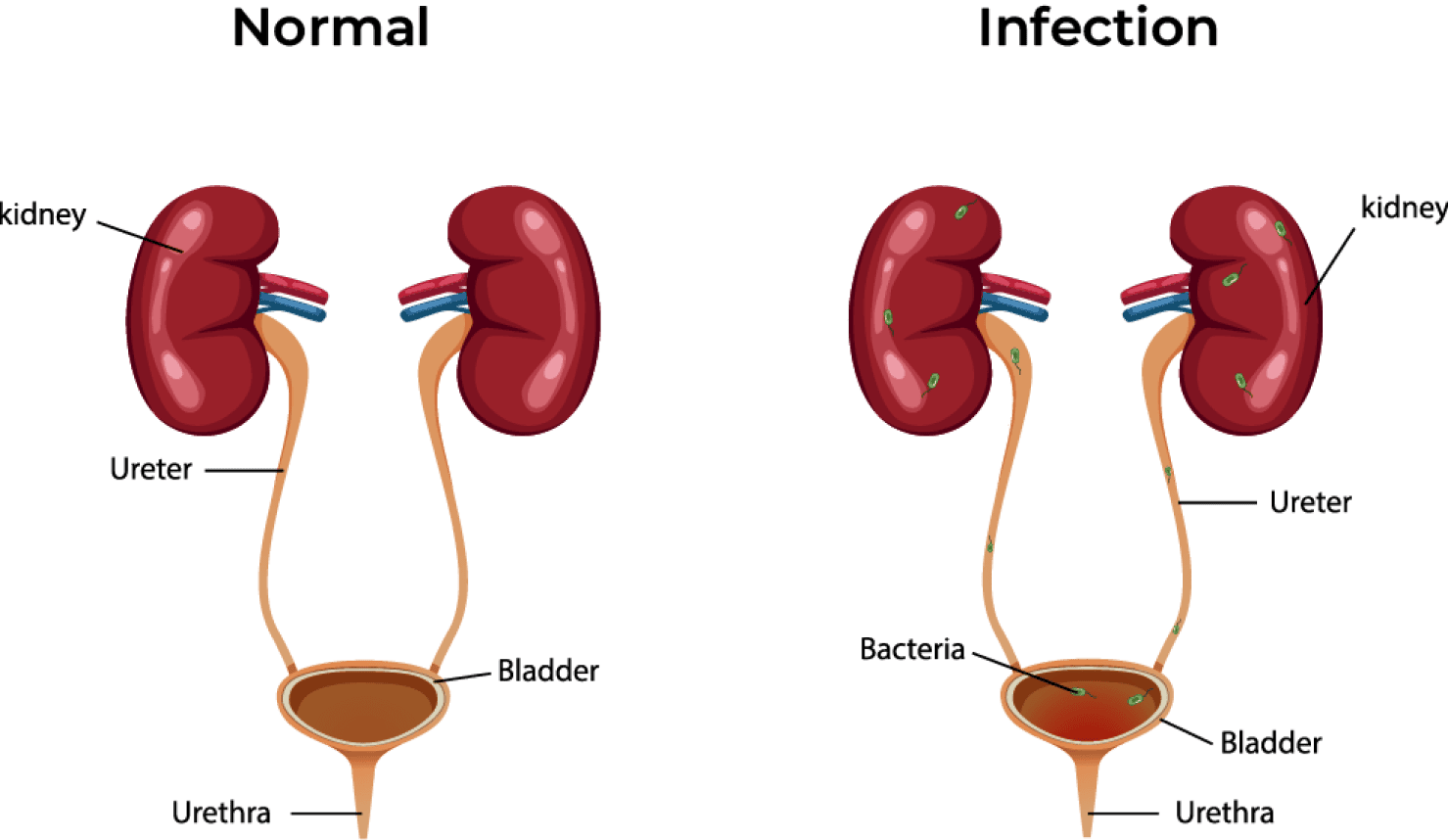 urinary Tract Infection